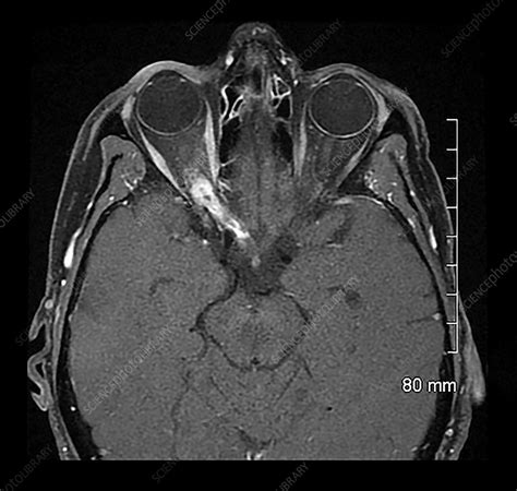 MRI Optic Nerve Glioma in Adult - Stock Image - C043/3045 - Science Photo Library