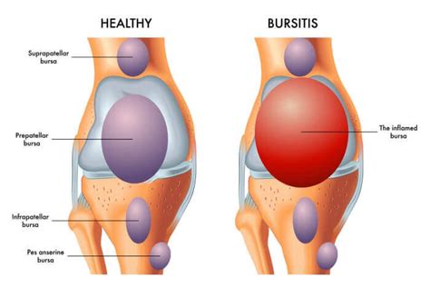 Is My Joint Pain Arthritis or BURSITIS? - Towson Orthopaedic Associates