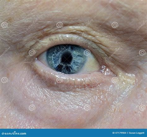 Iridocorneal Endothelial Syndrom Stock Photo - Image of iridocorneal, rare: 47179984