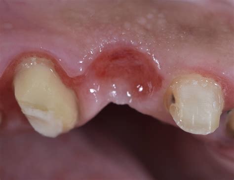 Dental Esthetics: Ovate pontic for the correct emergence profile.. A clinical case