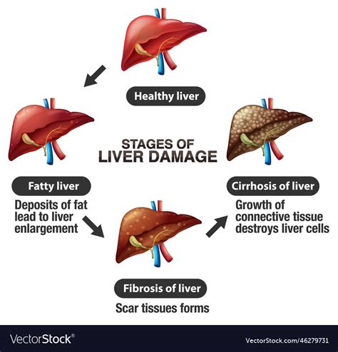 Stages of liver damage infographic Royalty Free Vector Image