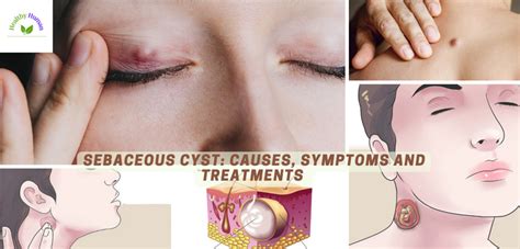 Sebaceous Cysts: Causes, Symptoms, and Treatments