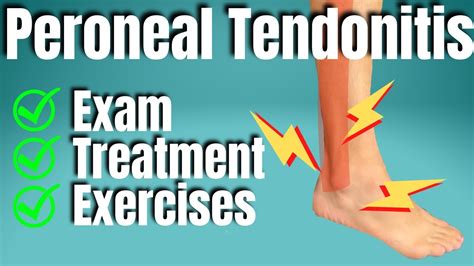 Peroneal Tendonitis Foot Hot Sale | cityofclovis.org