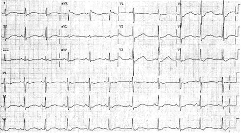 Hypokalemia Ecg