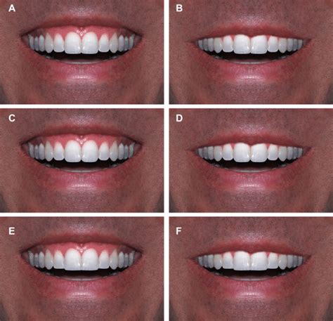 Male smiles after manipulations. A, Male smile with semi-rounded... | Download Scientific Diagram