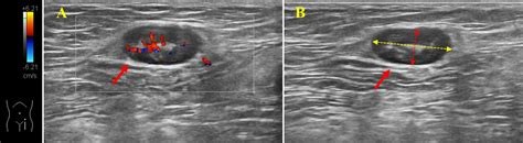 Groin Lymph Nodes