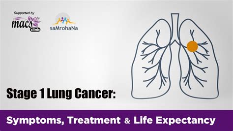 Stage 1 Lung Cancer: Symptoms, Treatment And Life Expectancy - Macs Clinic