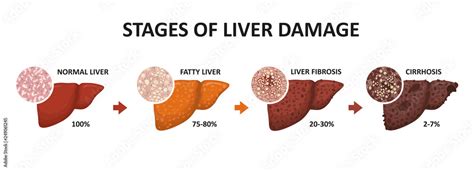 Stages of liver damage. Healthy, fatty, liver fibrosis and cirrhosis. Stock Vector | Adobe Stock