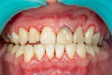 Understanding the Stages of Periodontal Disease