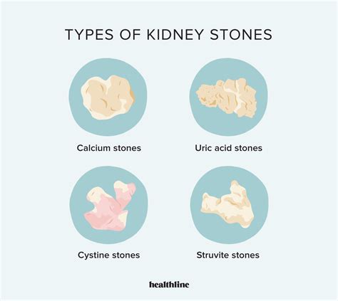 Kidney Stones Colors Types