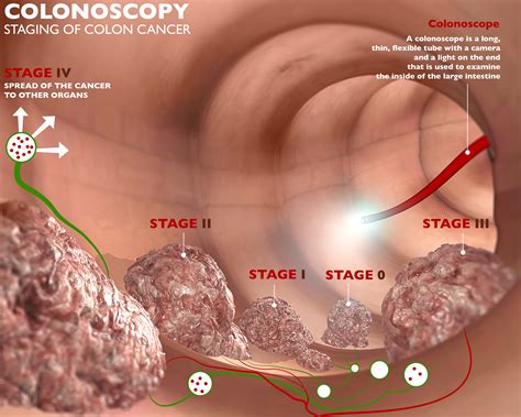 Colon Polyps - What You Need To Know