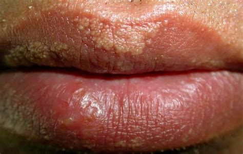 water blisters on lip - pictures, photos