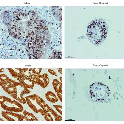 | Colon cancer organoids differentiation status. (A) PAS-positive ...