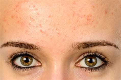 Fungal Acne: How to Know if You Have it ~ and How to Treat it