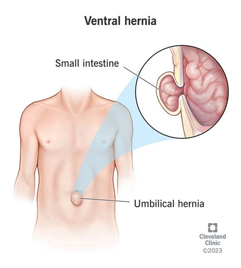 Hernia: What It Is, Symptoms, Types, Causes Treatment, 45% OFF