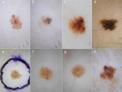 Melanoma pictures by stages | Symptoms and pictures