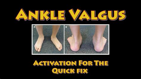 Ankle Valgus Correction - YouTube