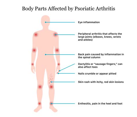 Psoriatic Arthritis | Symptoms, Causes, Diagnosis & Treatment