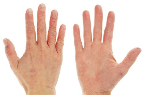 Rough Severely Dry Skin on Hand Causes and Treatment - Skincarederm