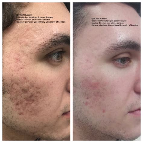 Acne Scar Laser Treatment & Removal London | Dr H Consult