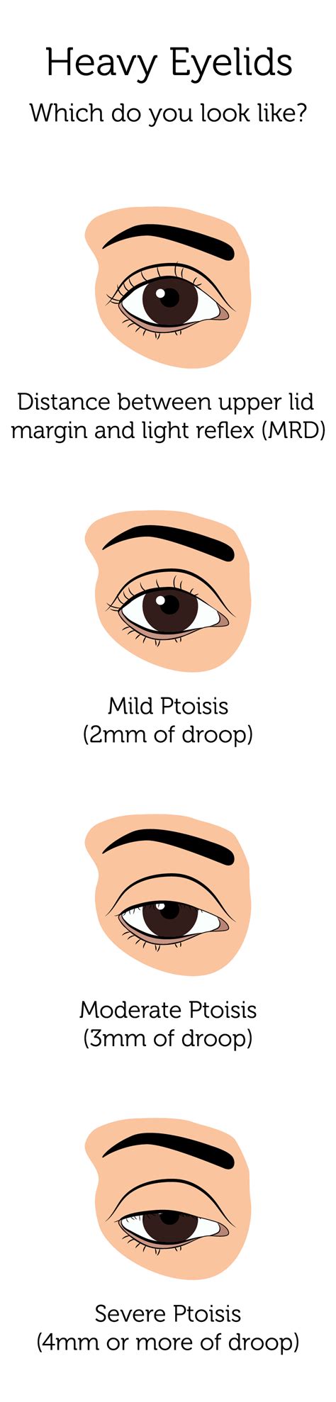 Heavy Eyelids | London | Rejuvence Clinic