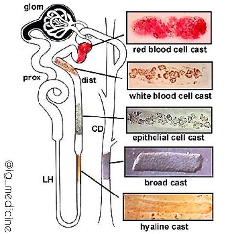 Casts in Urine @ig_medicine Presence of casts indicates that hematuria/pyuria is of renal (vs ...