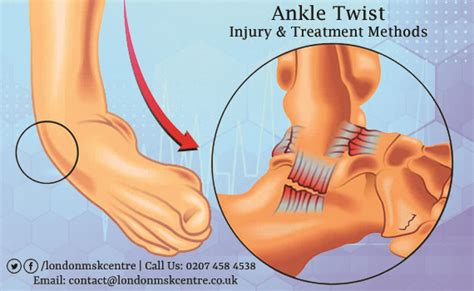 Ankle Twist Injury Treatment - London Musculoskeletal Centre ...