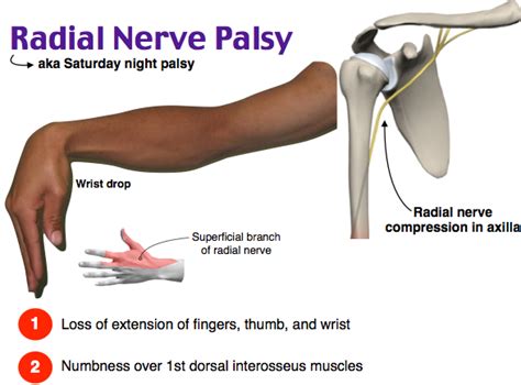 VASTRAL PHYSIOTHERAPY CLINIC: Radial Nerve Palsy And Physiotherapy ...