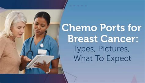 Chemo Ports for Breast Cancer: Types, Pictures, What To Expect | MyBCTeam