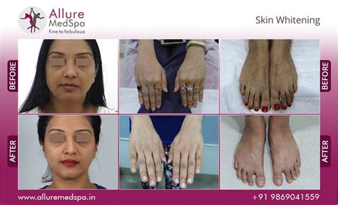 Skin Whitening Mumbai | Skin Whitening Treatment, Surgeon, Clinic, Cost Mumbai | AllureMedSpa