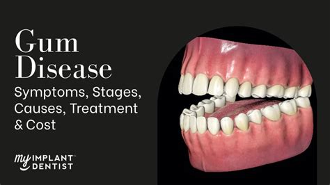 Gum Disease - Symptoms, Stages, Causes, Treatment & Cost