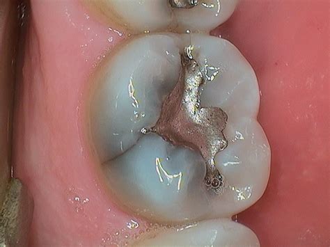 Cracked Tooth Syndrome | Dr. Ari Greenspan Dentist