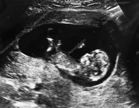 Ultrasound of fetus 3 months in the womb — Stock Photo © dianazh #9781266