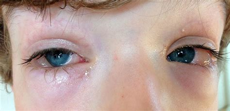 Palpebral Edema: Upper Eyelid, Lower Eyelid, Causes, Symptoms and Treatment - Scope Heal