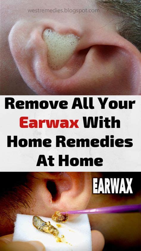 Fire ear wax removal - lopersperu