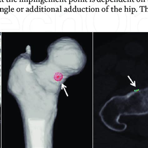 Identification of the impingement point by computer simulation.... | Download Scientific Diagram