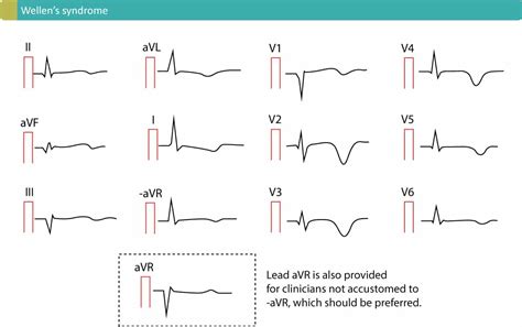 T-waves in ischemia: hyperacute, inversions, Wellens sign and de ...