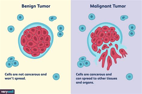 Benign Lung Tumors: Types, Characteristics, and Treatment