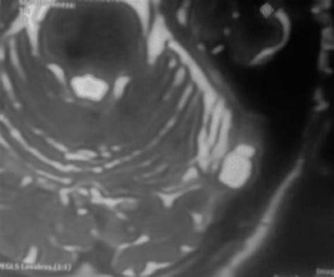 Arachnoid granulations on MRI - Sumer's Radiology Blog