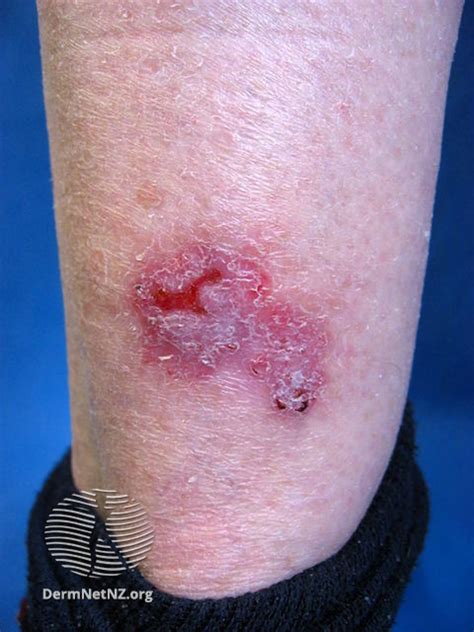 File:Basal cell carcinoma, leg (DermNet NZ bcc-leg-15-dn).jpg - NC Commons