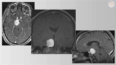 Anterior Petrosectomy for Upper Petroclival Meningioma | Operative Video Cases | The ...