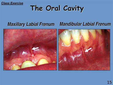 Mucogingival Junction Alv