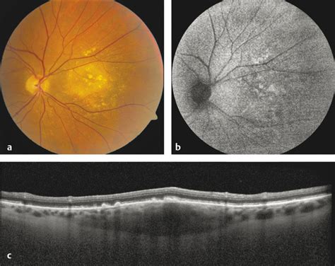 26 Choroidal Nevus and Melanoma | Ento Key