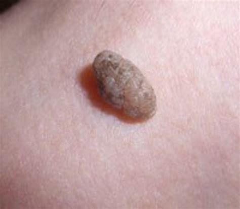 Skin Tags-Should You Be Concerned? | HubPages