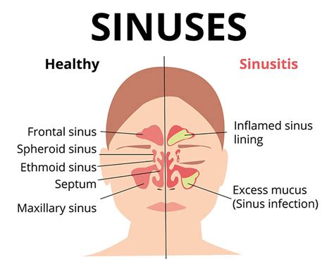 How To Diagnose Sinus Infection - Netwhile Spmsoalan