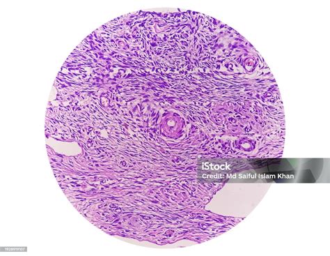 Histology Peritoneal Inclusion Cyst Paraovarian Cysts Hydrosalpinx And Lowgrade Cystic ...