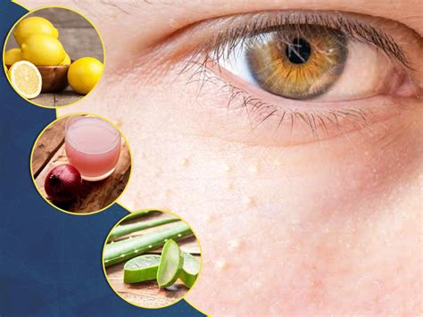 8 Effective Natural Remedies To Get Rid Of Bumps Around Your Eyes | OnlyMyHealth