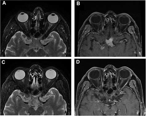 Normal Optic Nerve Mri