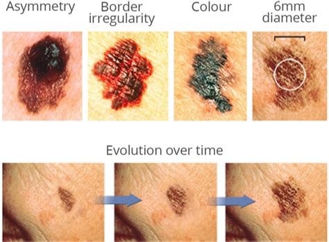 Benign Skin Cancer Types