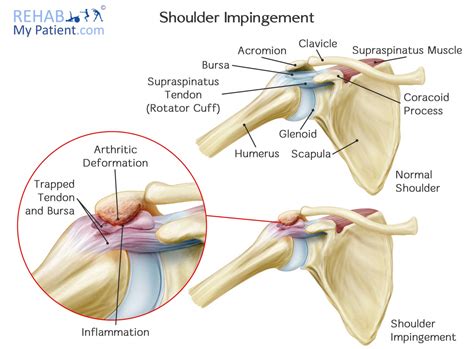 Shoulder Impingement Syndrome | Rehab My Patient